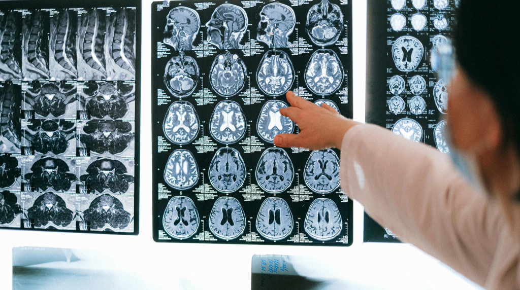 Arts die naar een bord wijst met diverse scans van iemands hersenen