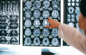 Arts die naar een bord wijst met diverse scans van iemands hersenen